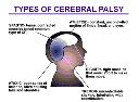 Best Stem cell therapy for Cerebral Palsy in India logo